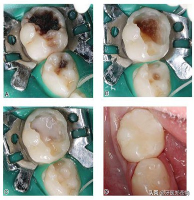 蛀牙疼不疼,蛀牙根管治疗疼不疼