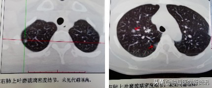 肺癌早期的6个信号中医治癌,肺癌正确的抗癌方法