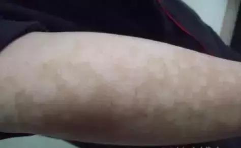 科普真菌感染性皮肤病的防治,专门治疗真菌皮肤病的药膏