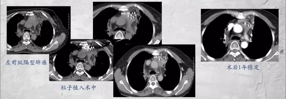 与肺癌病人一起生活需要注意什么,与肺癌抗战的第七个月