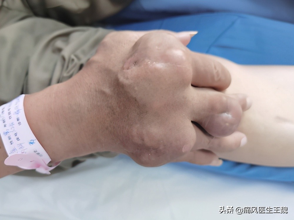 痛风为何根治不了,血尿酸与痛风十大误区你了解多少