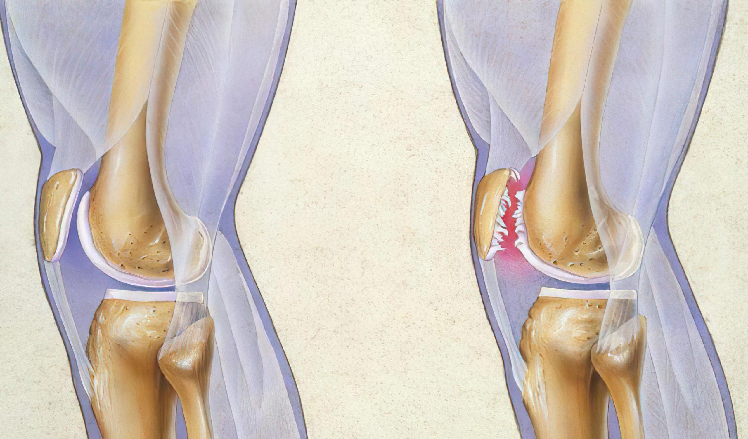 走路膝关节打软是什么病,走路打软腿是不是血管的问题