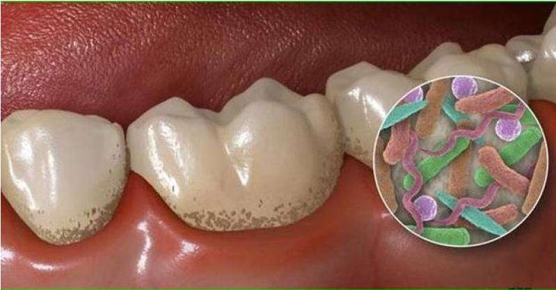 损伤了牙釉质该怎么修复,关于牙釉质损伤怎么修复