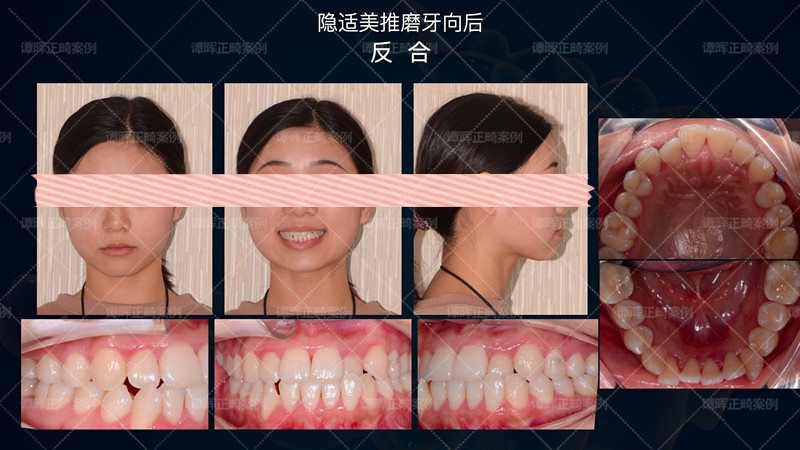 隐适美不拔牙矫正嘴凸,隐适美拔牙矫正三个月有效果吗