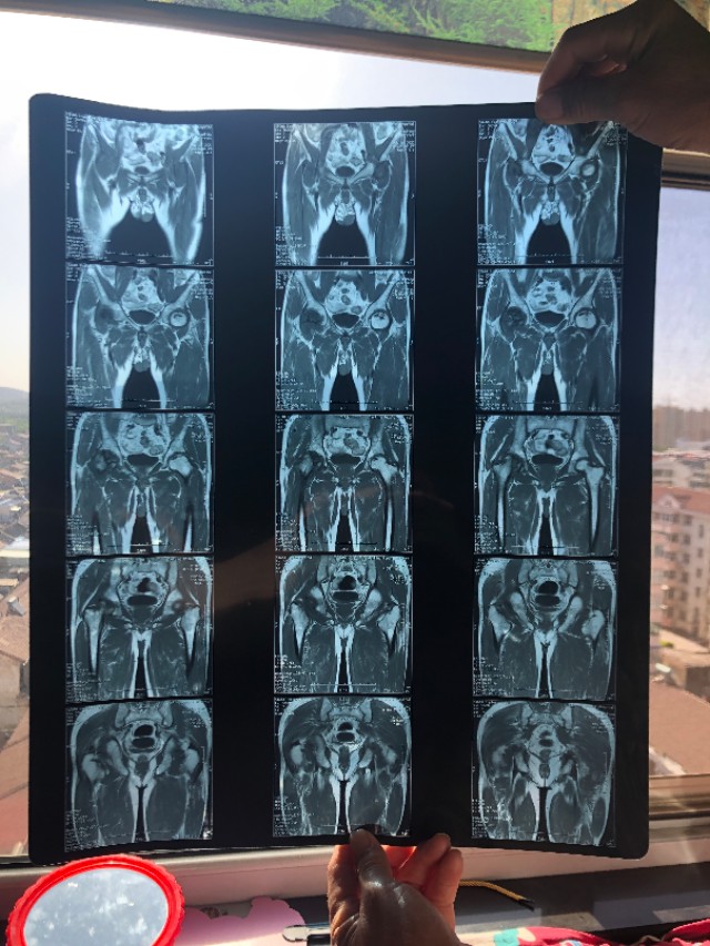 股骨头坏死医院怎么样治疗,股骨头无菌性坏死病因是多少种