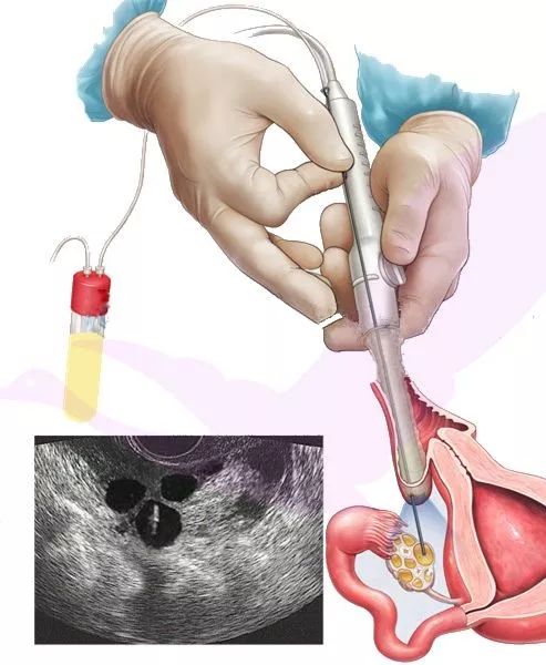 女孩*市黑**卖卵赚钱?身体的疼,还不是最可怕的