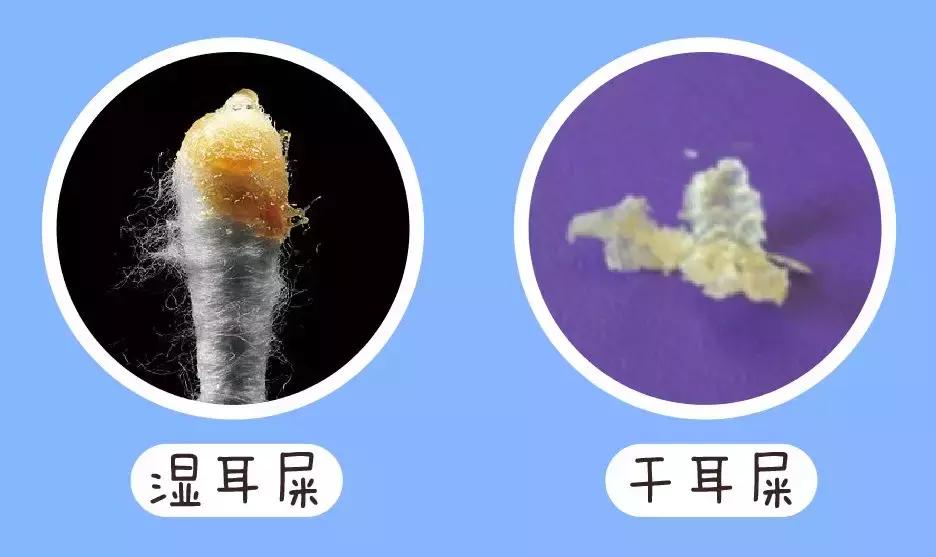 医院怎么给小朋友清理耳屎,孩子多久需要去一次医院清理耳屎