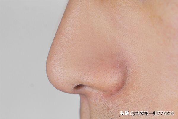 鼻子红红的一挤有白色分泌物,鼻子两边一挤很多白的分泌物