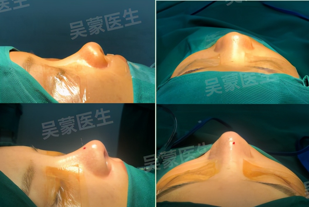 鞠婧祎鼻子整过吗,鞠婧祎的鼻子整过吗