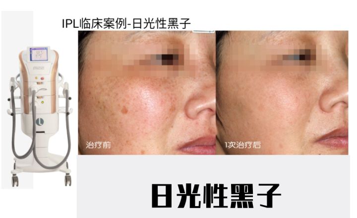 哪种医美项目祛痘印最有效,最有效的医美抗衰项目