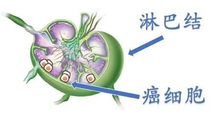 甲状腺术后见异常淋巴结什么意思,甲状腺术后病理有淋巴结转移2枚