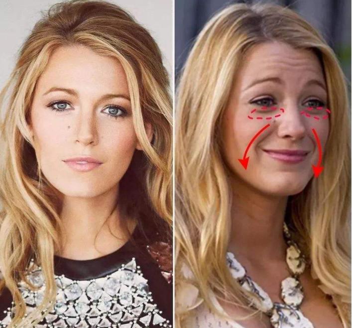 法令纹又深又长最好的解决办法,法令纹最显老怎么去除法令纹