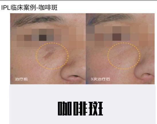 哪种医美项目祛痘印最有效,最有效的医美抗衰项目