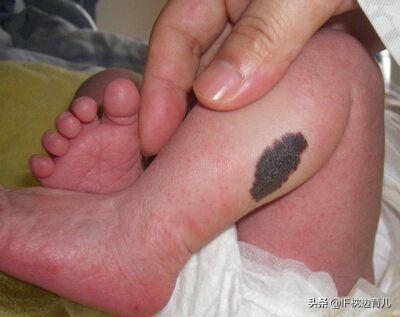 怎么避免宝宝出生有胎记,出生宝宝有胎记是孕期怎么导致的