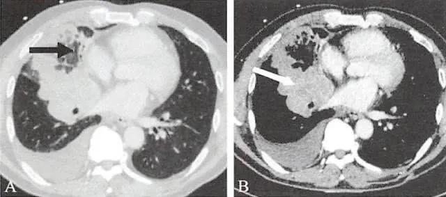 肺癌研究心得,我对癌症患者讲实话