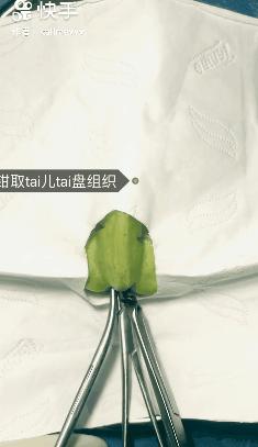 香蕉割包皮,洋葱剖腹产?这是我见过最秀的医生