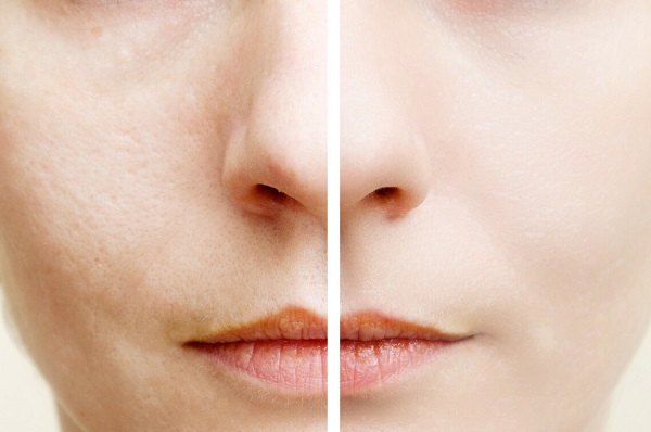 鼻子毛孔有黑头毛孔粗大怎么办,如何改善毛孔粗大有黑头