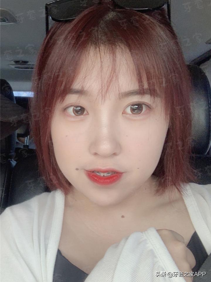 不靠整容怎么改变下巴后缩?看这里