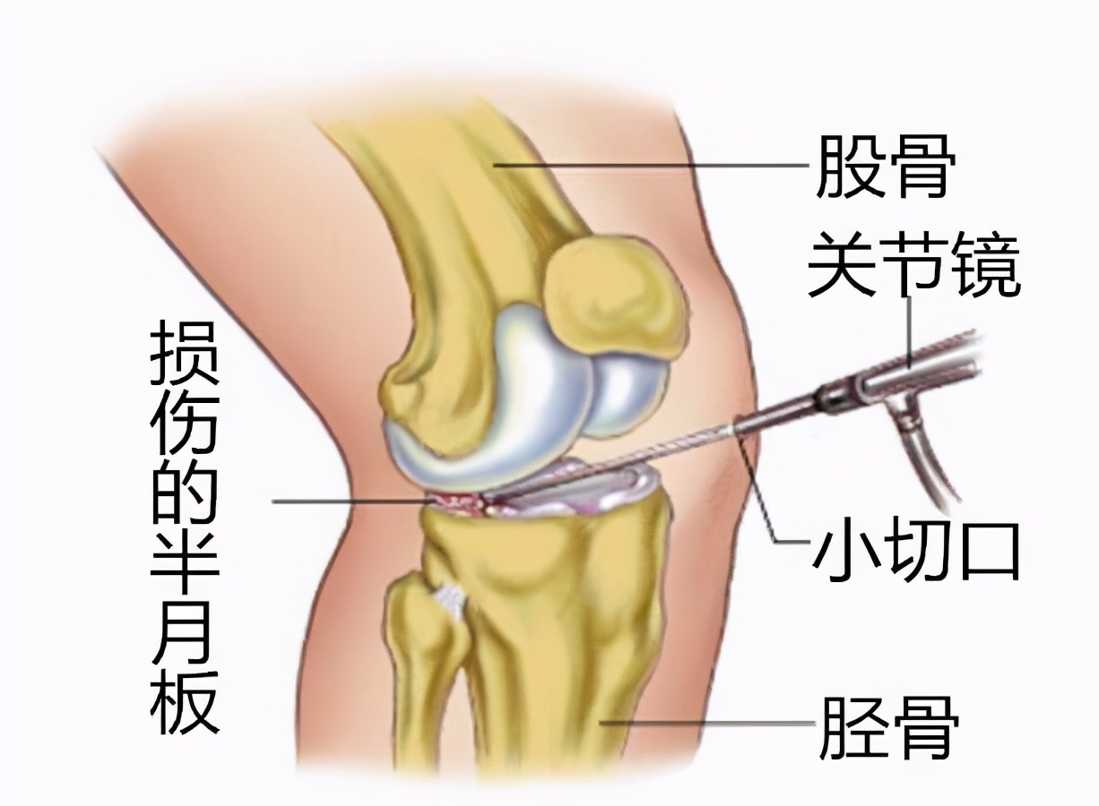 膝盖走路感觉有卡壳,膝盖走路卡壳了怎么回事