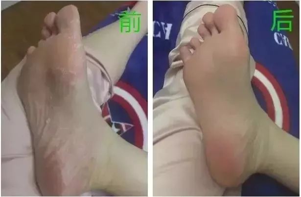 冬天脚后跟干裂用什么润脚霜,润足脚后跟干裂修复霜