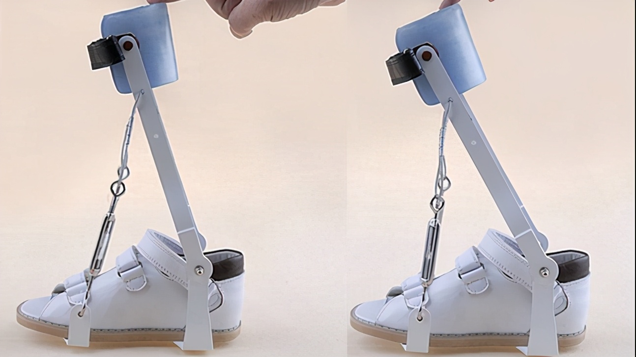 孩子足外翻买什么鞋矫正,儿童足外翻矫正鞋去哪里做