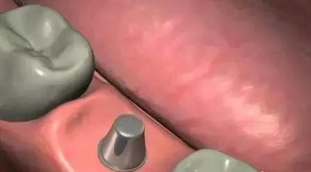 3d打印种植牙与传统种植牙的区别,种植牙是怎样种植的如何操作