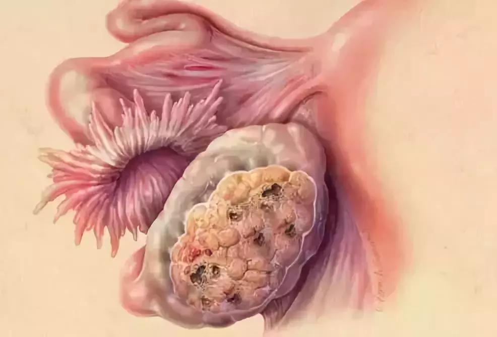 孕检很重要,怀孕会让卵巢囊肿跟着变大吗