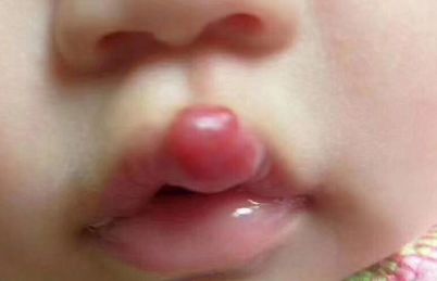 新生儿红胎记与血管瘤区别,红胎记血管瘤的最佳消除方法