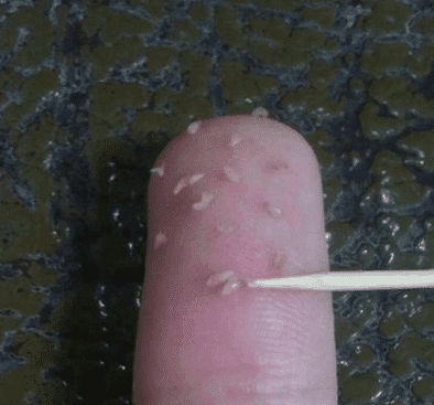 鼻头螨虫有什么药可以根治,鼻头上有螨虫用什么药