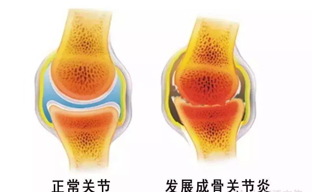 走路经常腿打软是怎么回事,走路经常腿打软当心膝盖出了问题