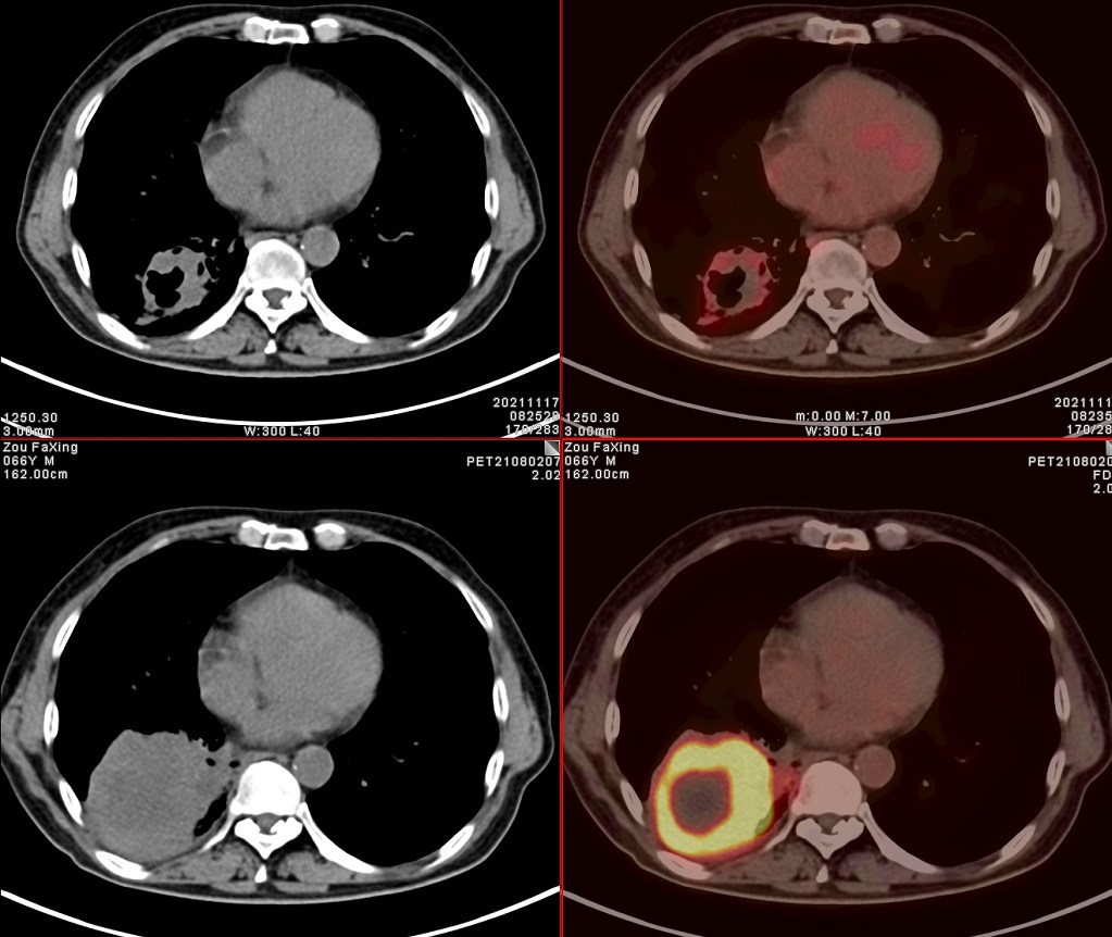 petct肺癌晚期必须要做吗,肺癌患者petct