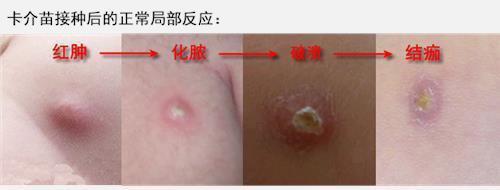卡介苗接种部位化脓,卡介苗接种部位化脓了怎么办
