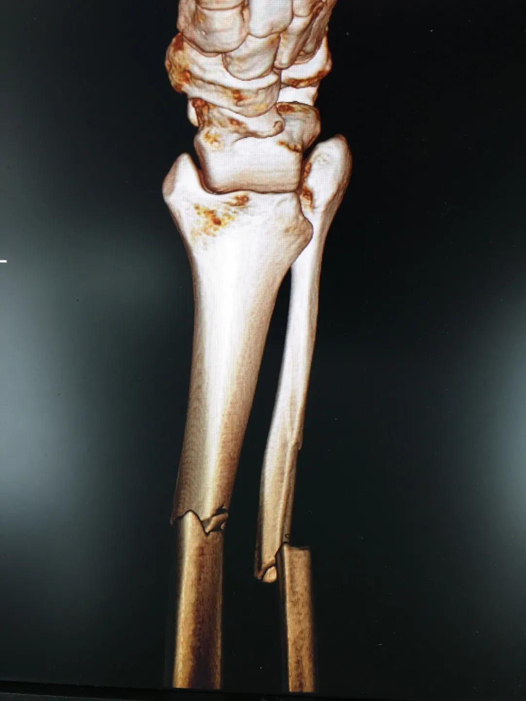 小腿挤压大量淤血能在家自愈吗,小腿碎成三截还能复原吗