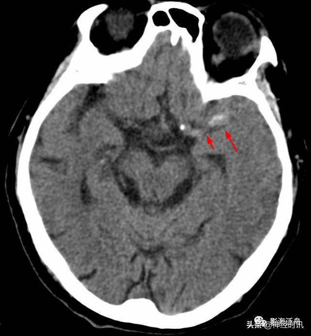 蛛血的临床表现,蛛血ct表现