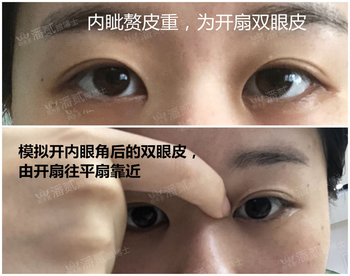 开内眼角失败留疤了怎么办,开外眼角恢复期间会有紧绷感么