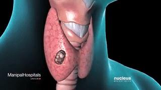 身上痒一检查竟是癌!皮肤出现小红疹,别大意!赶紧去检查甲状腺