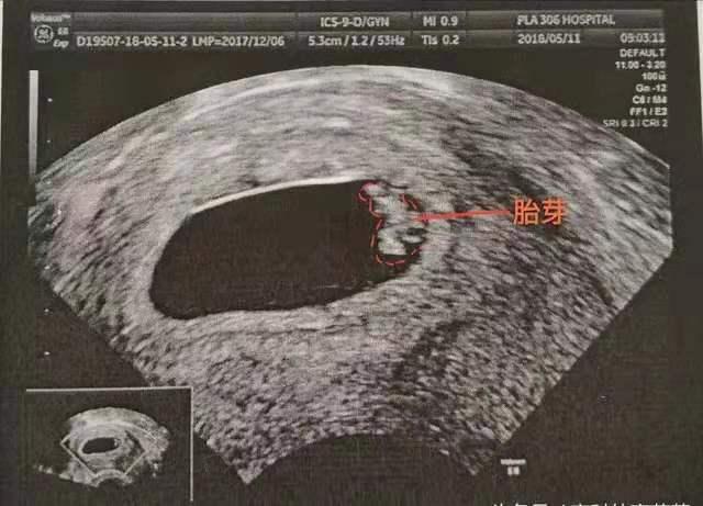 怀孕8周做b超挂什么科,孕7周b超有胎心10周会出现胎停吗