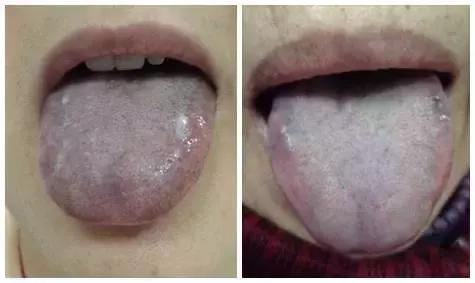 舌头辨体质,看舌头能看出几种体质