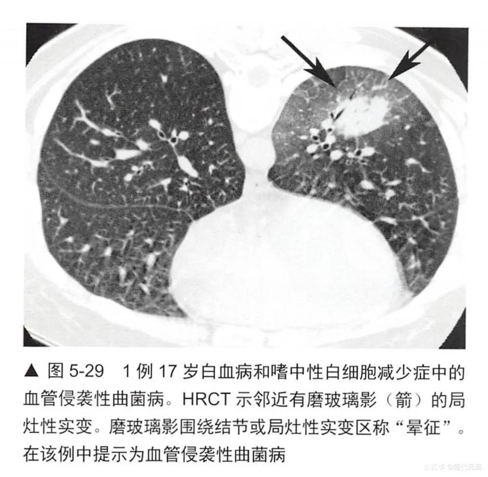 肺hrct诊断思路,肺部hrct检查呈阳性