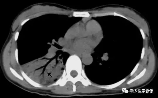 肺部基础免疫,肺基础疾病有哪些