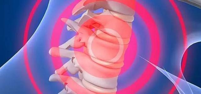 椎动脉型颈椎病会引起走路不稳吗,椎动脉型颈椎病如何治疗最好