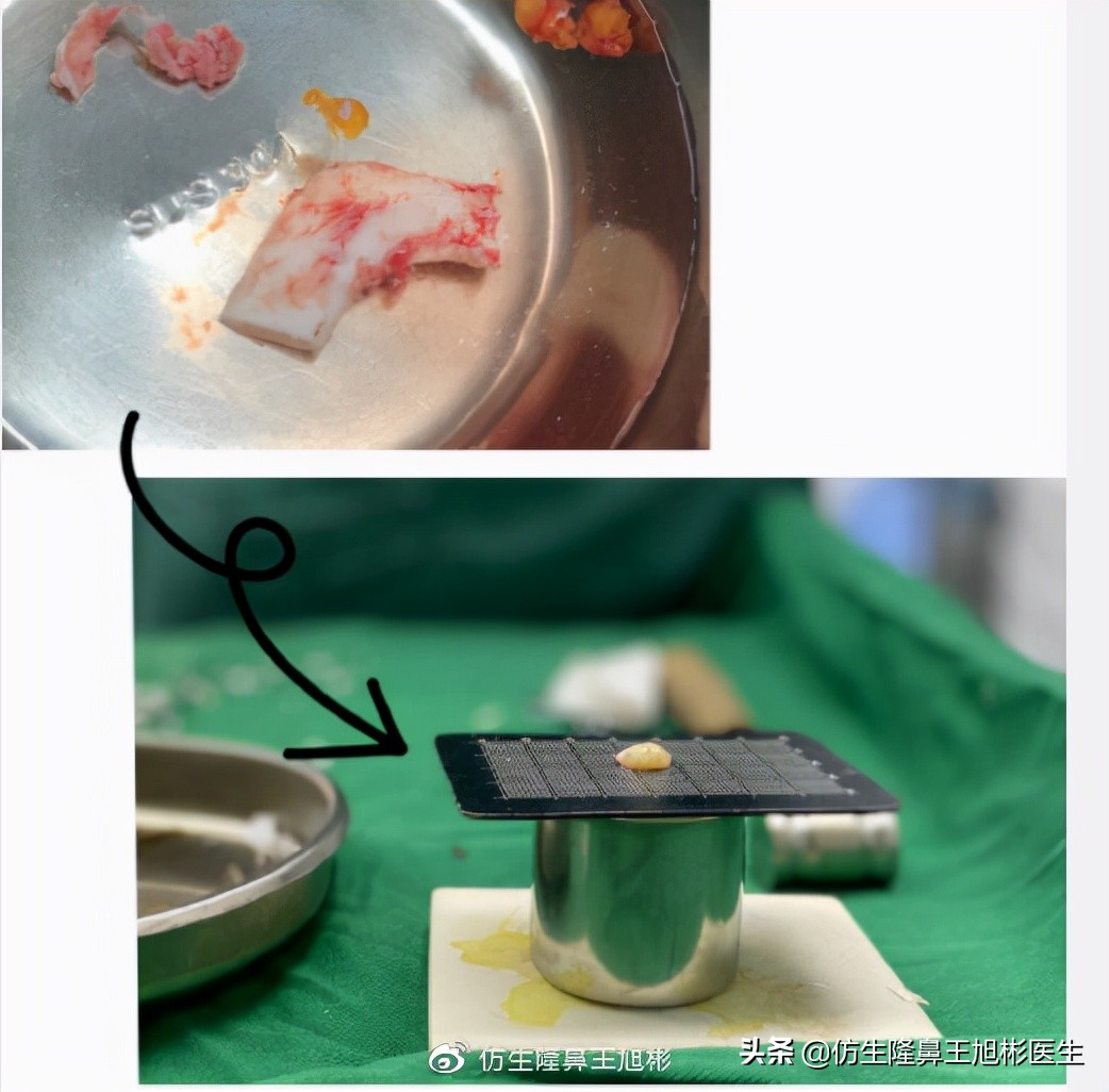 那些被鼻子“封印”颜值的鼻综合/修复案例|广州鼻整形
