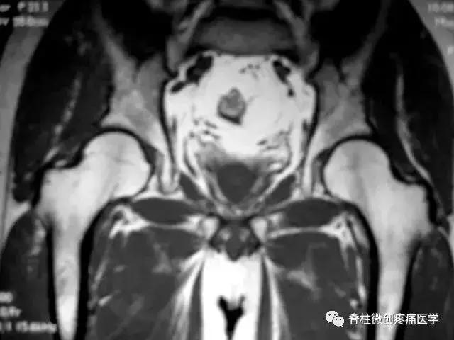 早期股骨头坏死核磁共振怎么看,股骨头坏死磁共振表现及分期