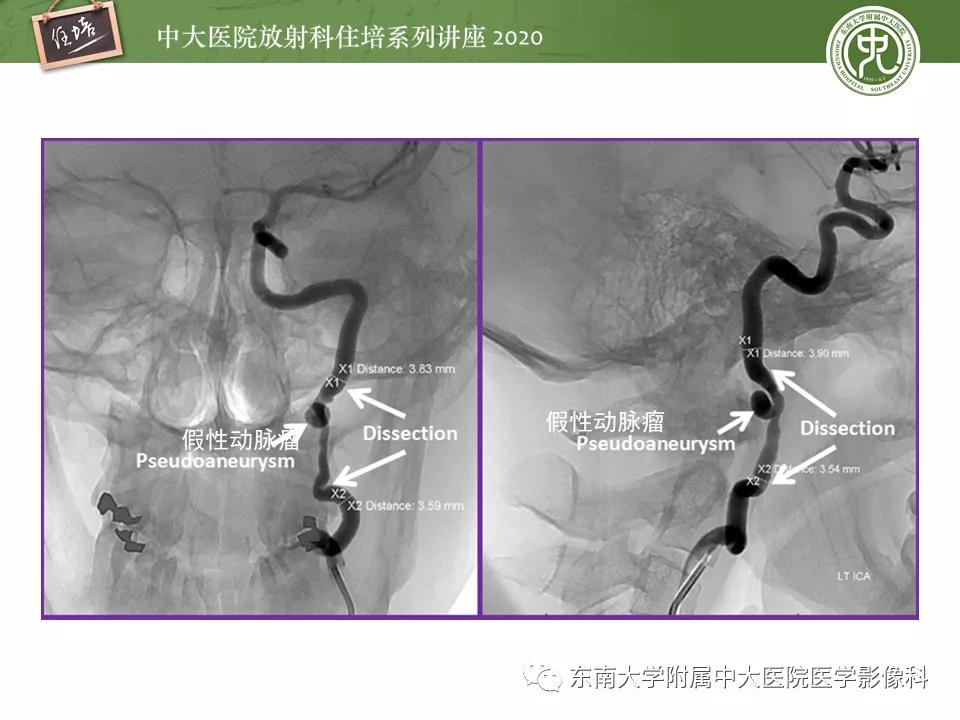 颈动脉夹层的超声表现及漏诊分析,动脉夹层与夹层动脉瘤是一样的吗