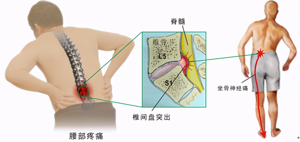 影像诊断腰间盘突出,影像学如何反映腰椎间盘突出好转
