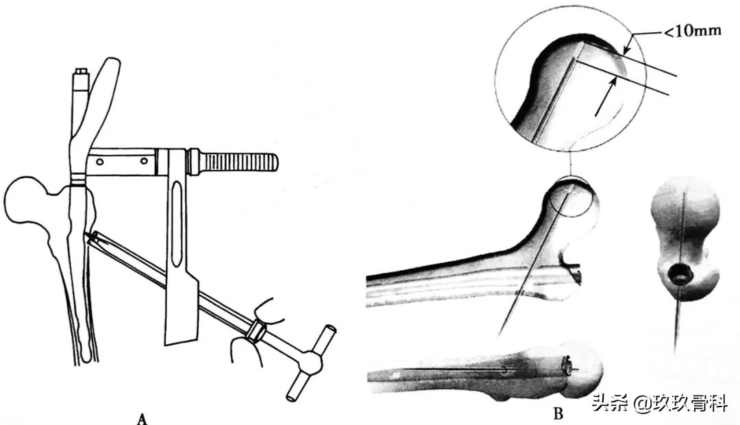 骨科用髓内钉什么材料,骨科髓内钉的作用