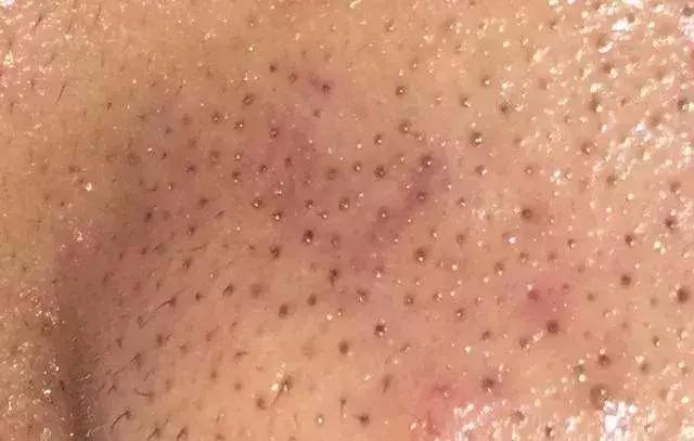 你知道黑头是怎么形成的吗,怎么分辨黑头的严重程度