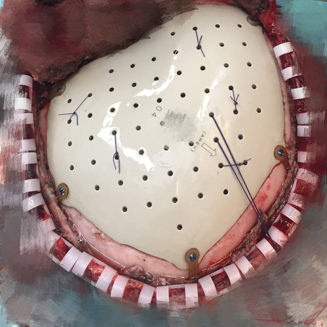 头骨缺失是什么原因,头骨不修补有什么后遗症