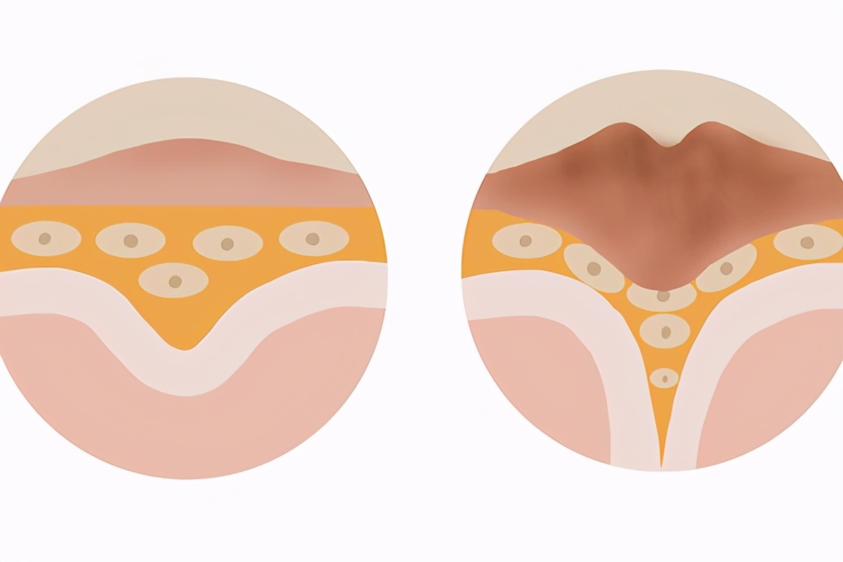 脚上长鸡眼最简单的去除方法,脚上长的鸡眼的处理方法