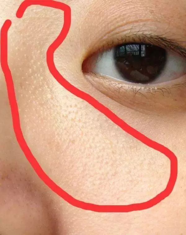 祛除闭合性粉刺软膏有哪些,下巴有闭合性粉刺怎么祛除